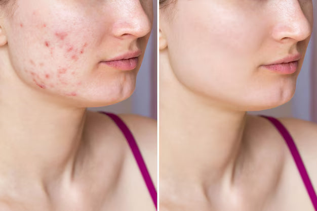 Kit Antiacné 3pz - Pure Skin Bioaqua